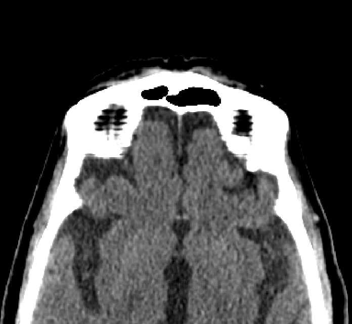 Bilateral ectopia lentis (Radiopaedia 89889-107013 Axial non-contrast 4).jpg