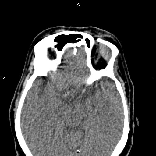 Bilateral enlargement of lacrimal glands - sarcoidosis (Radiopaedia 62627-70921 Axial non-contrast 62).jpg