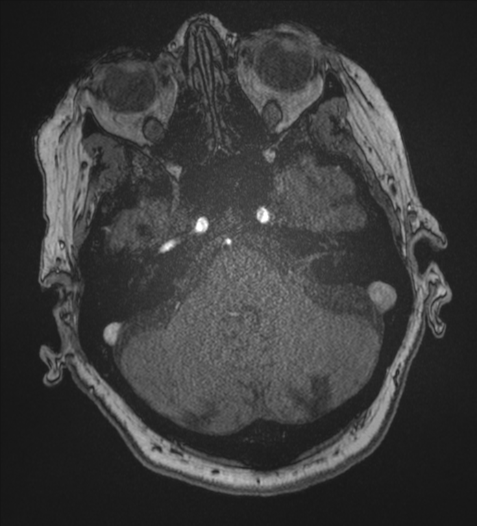 Bilateral fetal posterior communicating arteries (Radiopaedia 41286-44102 Axial MRA 40).png