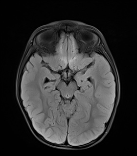 File:Bilateral mesial temporal polymicrogyria (Radiopaedia 76456-88181 Axial FLAIR 10).jpg