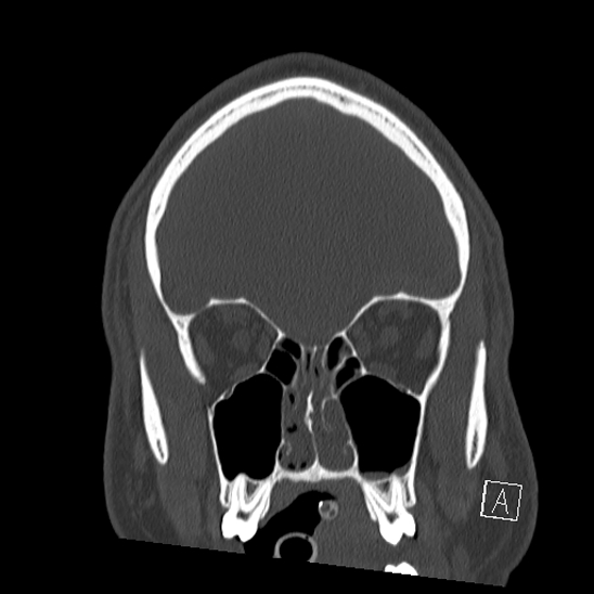 Bilateral occipital condyle fracture (type 2) (Radiopaedia 87675-104089 Coronal bone window 19).jpg