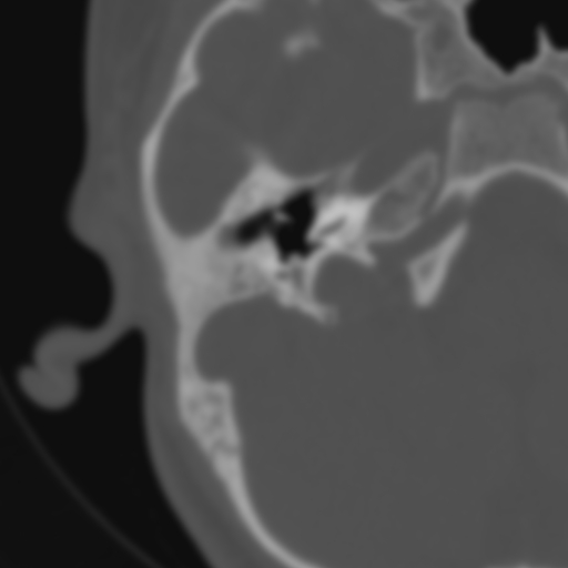 Bilateral otosclerosis (Radiopaedia 57237-64157 B 50).jpg
