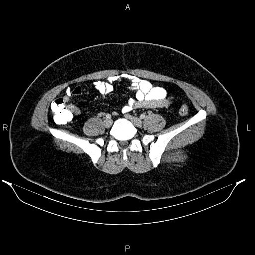 Bilateral ovarian dermoid cysts (Radiopaedia 85785-101603 A 74).jpg