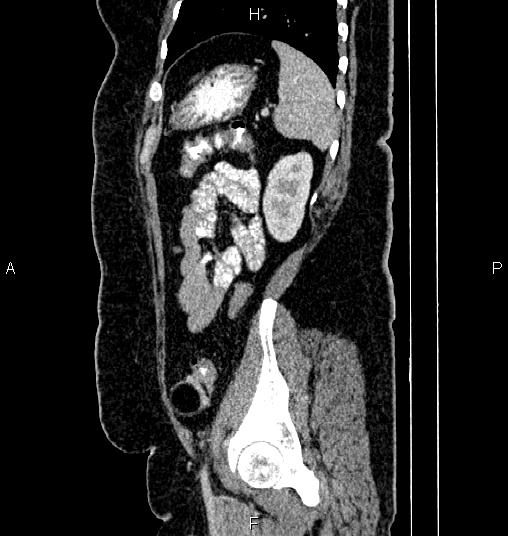 Bilateral ovarian dermoid cysts (Radiopaedia 85785-101603 D 75).jpg