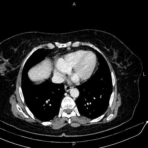 Bilateral ovarian serous cystadenocarcinoma (Radiopaedia 86062-101989 B 10).jpg