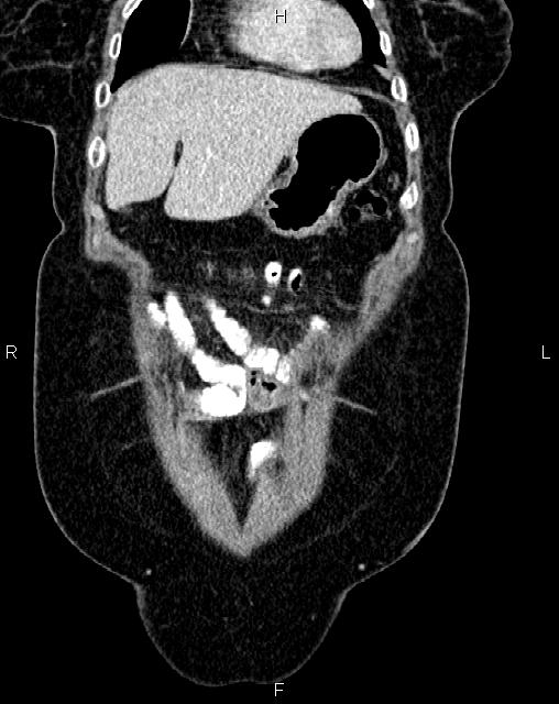 Bilateral ovarian serous cystadenocarcinoma (Radiopaedia 86062-101989 D 1).jpg