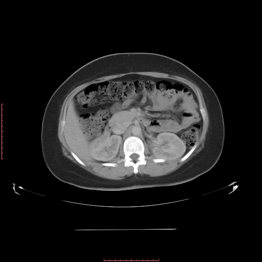 File:Bilateral ovarian serous cystadenocarcinoma with right ovarian torsion (Radiopaedia 32640-33611 A 15).jpg