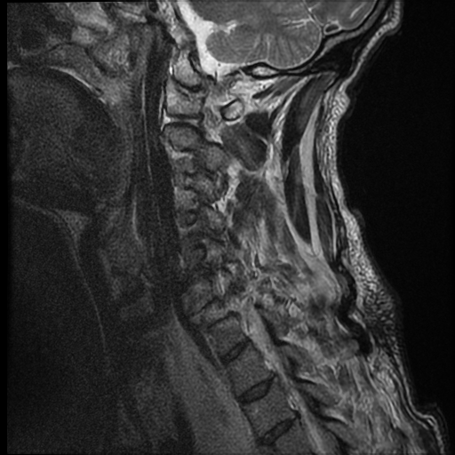 File:Bilateral perched facets with cord injury (Radiopaedia 45587-49714 Sagittal T2 4).jpg