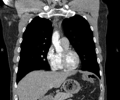 Bilateral pulmonary AVM (Radiopaedia 83134-97505 C 27).jpg