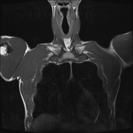 File:Bilateral spinoglenoid notch ganglion cysts (Radiopaedia 29577-30082 Coronal T1 3).jpg