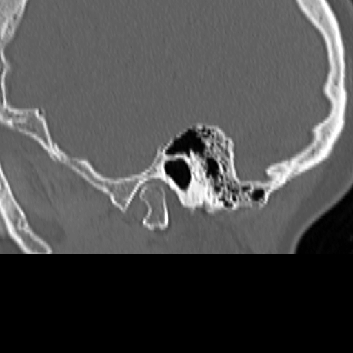 Bilateral tympanoplasty (Radiopaedia 16947-16664 Sagittal bone window 12).jpg