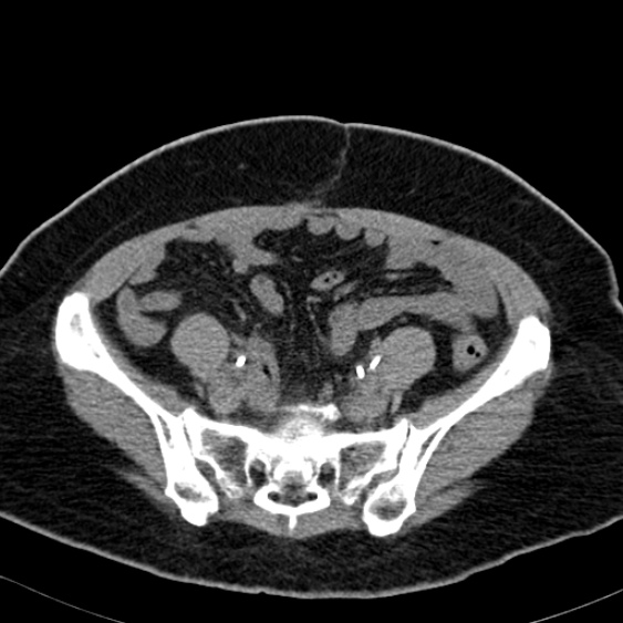 File:Bilateral ureteric stents (Radiopaedia 48795-53825 Axial non-contrast 46).jpg