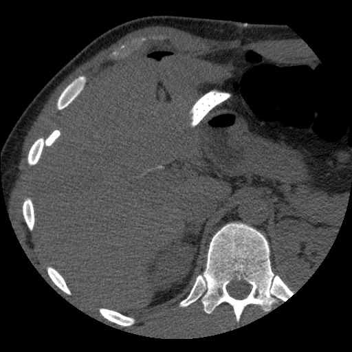 Bile leak from liver traumatic laceration (Radiopaedia 63463-72077 Axial Biliscopin 36).jpg