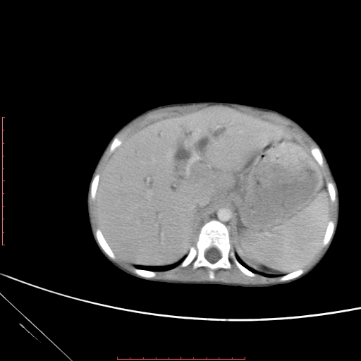 Biliary tract embryonal rhabdomyosarcoma (Radiopaedia 51815-57648 A 18).jpg
