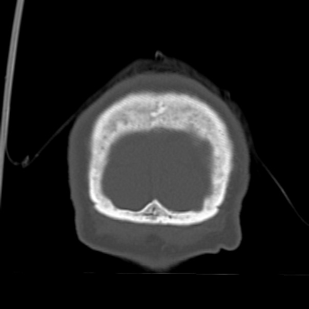 Biparietal osteodystrophy (Radiopaedia 46109-50463 Coronal bone window 100).jpg