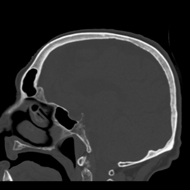 Biparietal osteodystrophy (Radiopaedia 46109-50463 Sagittal bone window 57).jpg