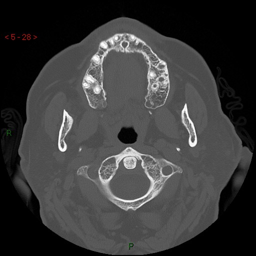 Bisphosphonate-related osteonecrosis of the jaw (Radiopaedia 54147-60329 Axial bone window 22).jpg