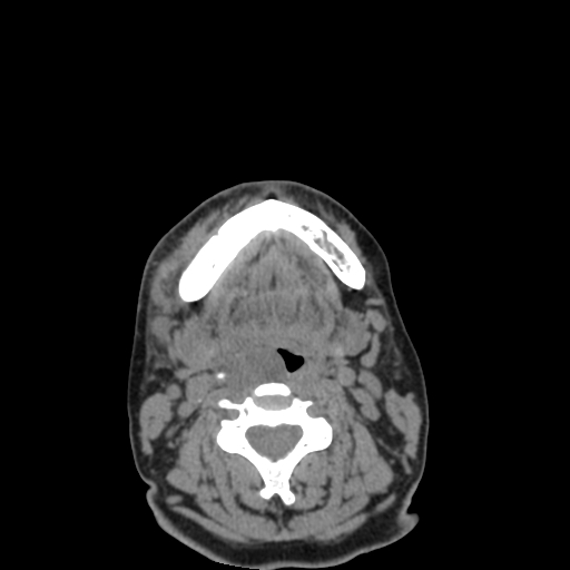 Bisphosphonate-related osteonecrosis of the jaw (Radiopaedia 71324-81642 non-contrast 36).jpg