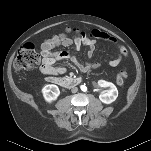 File:Bladder papillary urothelial carcinoma (Radiopaedia 48119-52951 A 26).png