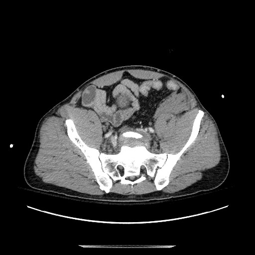 Blunt abdominal trauma with solid organ and musculoskelatal injury with active extravasation (Radiopaedia 68364-77895 A 121).jpg