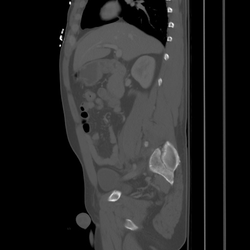 Blunt abdominal trauma with solid organ and musculoskelatal injury with active extravasation (Radiopaedia 68364-77895 Sagittal bone window 35).jpg