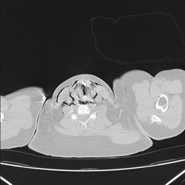 Boerhaave syndrome (Radiopaedia 45644-49799 Axial lung window 14).jpg