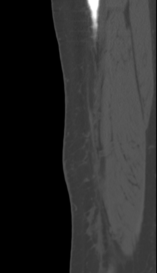 Bone metastasis - tibia (Radiopaedia 57665-64609 Sagittal bone window 25).jpg