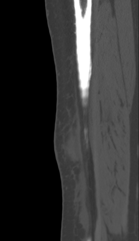Bone metastasis - tibia (Radiopaedia 57665-64609 Sagittal bone window 35).jpg