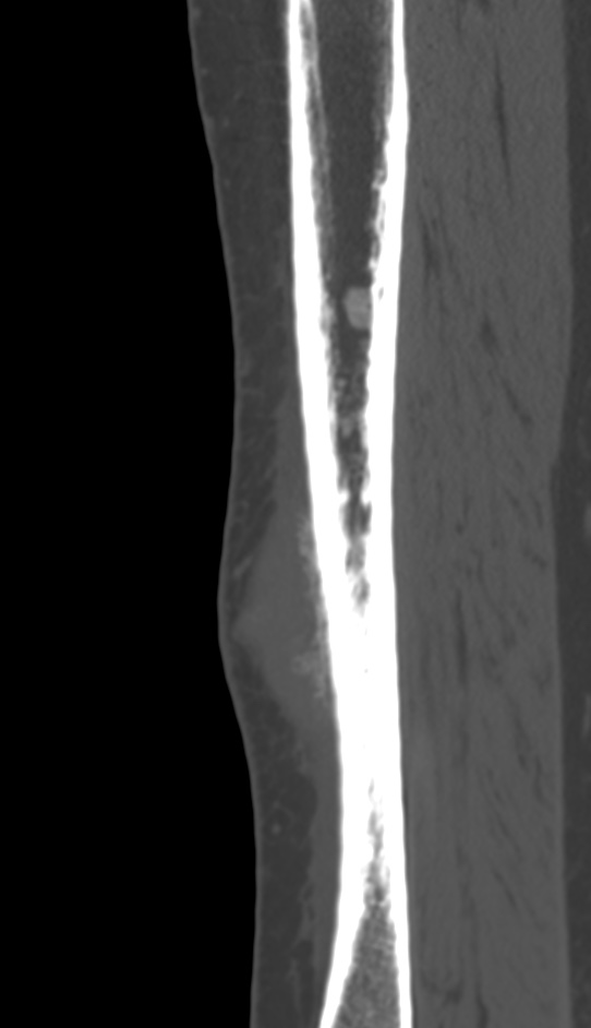 Bone metastasis - tibia (Radiopaedia 57665-64609 Sagittal bone window 56).jpg