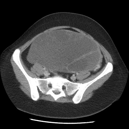 File:Borderline mucinous tumor (ovary) (Radiopaedia 78228-90808 A 114).jpg