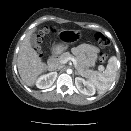 File:Borderline mucinous tumor (ovary) (Radiopaedia 78228-90808 A 49).jpg