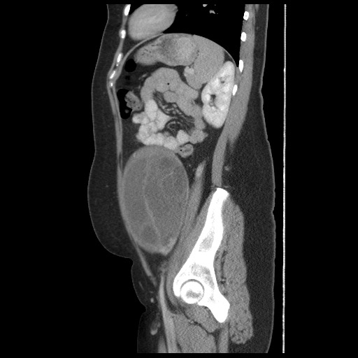 Borderline mucinous tumor (ovary) (Radiopaedia 78228-90808 B 48).jpg