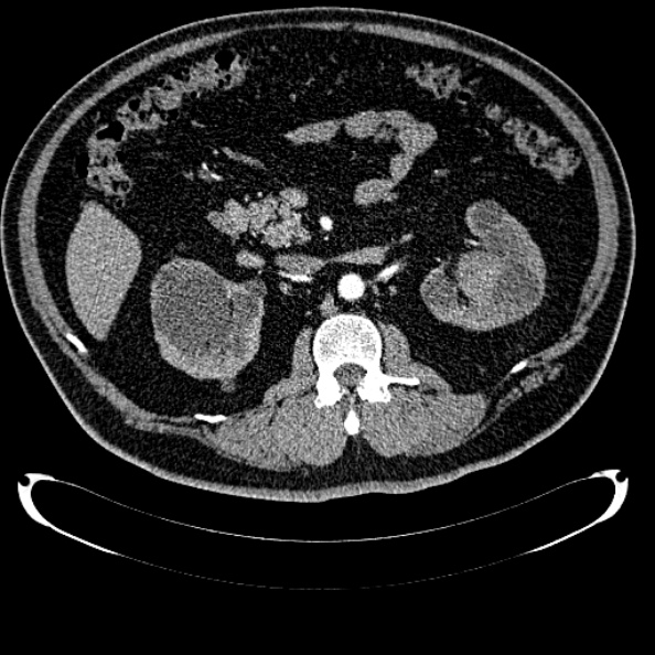 Bosniak renal cyst - type IV (Radiopaedia 24244-24518 B 136).jpg
