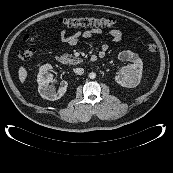 Bosniak renal cyst - type IV (Radiopaedia 24244-24518 C 157).jpg