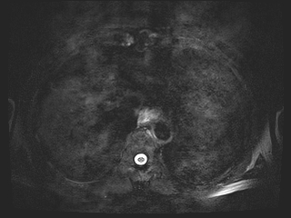 File:Bouveret syndrome (Radiopaedia 61017-68856 Axial MRCP 5).jpg