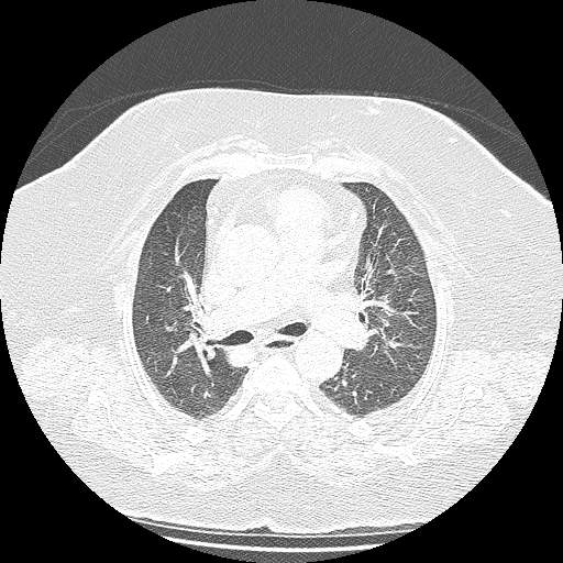 Bovine aortic arch - right internal mammary vein drains into the superior vena cava (Radiopaedia 63296-71875 Axial lung window 63).jpg