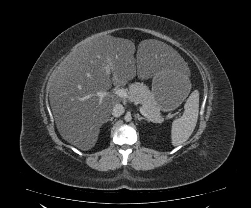 Bowel and splenic infarcts in acute lymphocytic leukemia (Radiopaedia 61055-68913 A 48).jpg