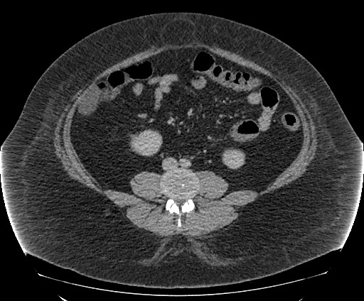 Bowel and splenic infarcts in acute lymphocytic leukemia (Radiopaedia 61055-68913 A 77).jpg