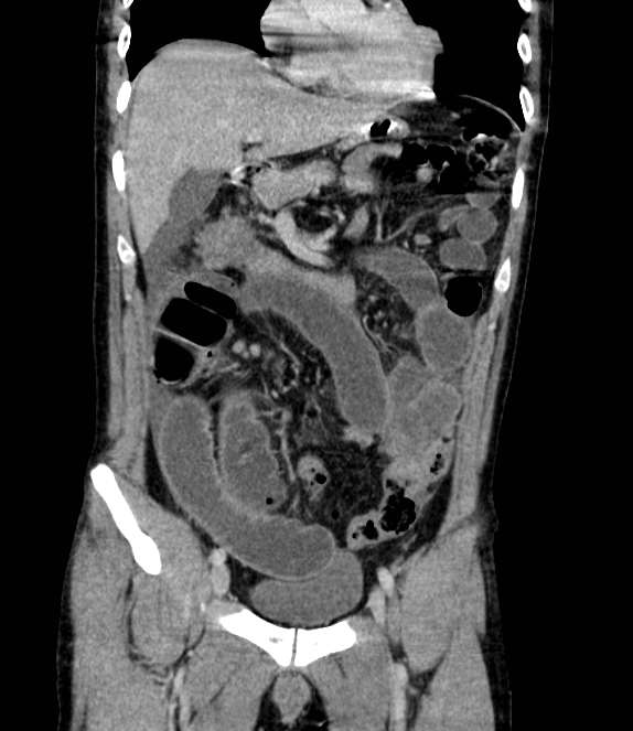 Bowel obstruction from colon carcinoma (Radiopaedia 22995-23028 C 26).jpg