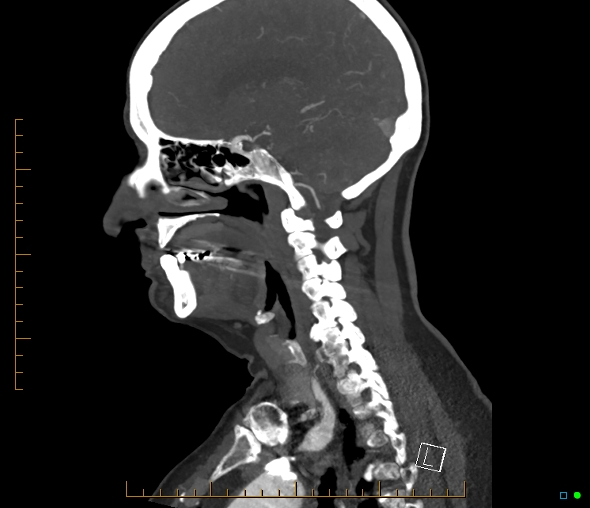 Brachiocephalic trunk stenosis (Radiopaedia 87242-103519 C 38).jpg