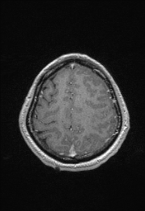 Brain abscess with ventriculitis (Radiopaedia 85703-101495 Axial T1 C+ 140).jpg