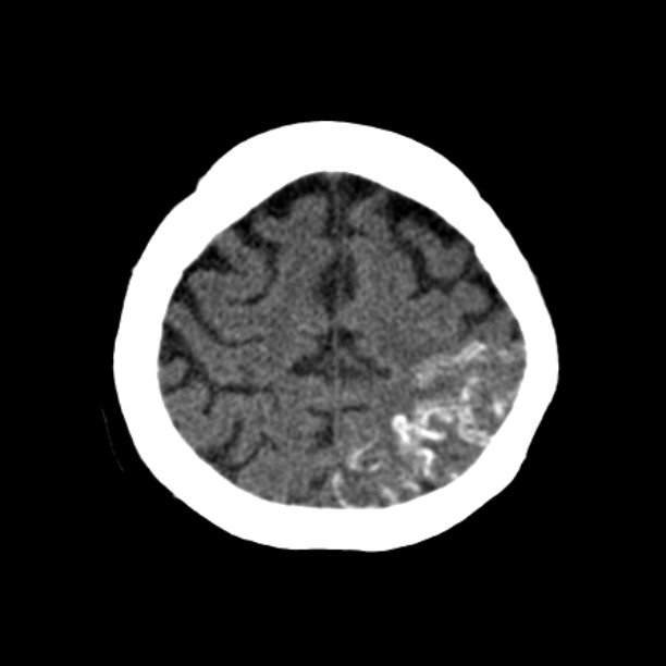 Brain cortical laminar necrosis (Radiopaedia 25822-25971 Axial non-contrast 38).jpg