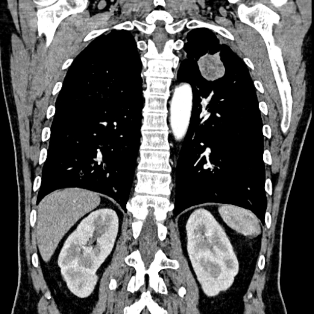 Brain metastases - lung cancer primary (Radiopaedia 75060-86116 C+ arterial phase 50).jpg
