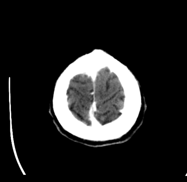 File:Brain metastases from lung cancer (Radiopaedia 24480-24781 Axial C+ delayed 59).jpg