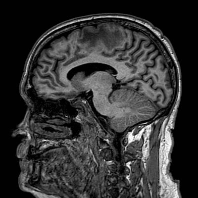 Brain metastases from lung cancer (Radiopaedia 83839-99028 Sagittal T1 73).jpg