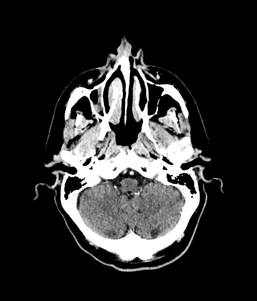 Brain metastasis (large cystic mass) (Radiopaedia 47497-52106 Axial C+ 16).png
