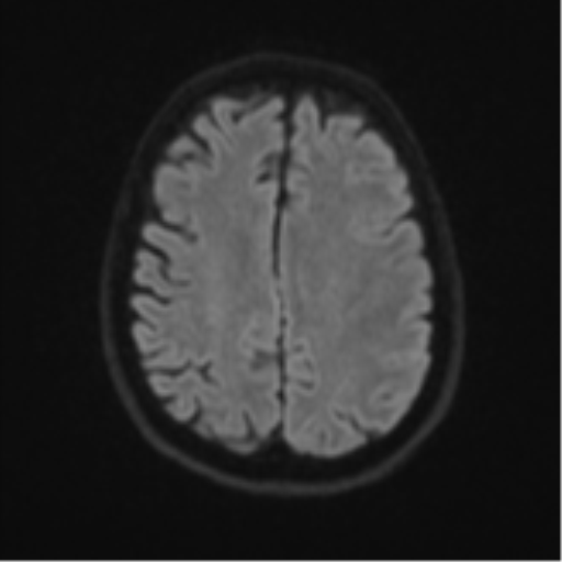 File:Brain metastasis (large cystic mass) (Radiopaedia 47497-52107 Axial DWI 47).png