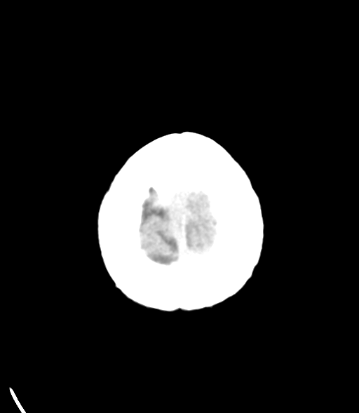 File:Brain metastasis (lung cancer) (Radiopaedia 48289-53177 Axial non-contrast 33).png