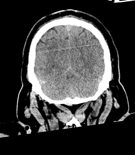 Brainstem hemorrhage (Radiopaedia 81294-94976 Coronal non-contrast 56).jpg