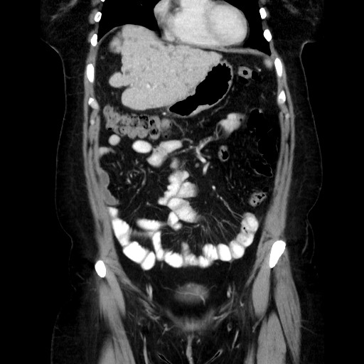 File:Breast cancer pseudocirrhosis after chemotherapy (Radiopaedia 65407-74457 B 38).jpg